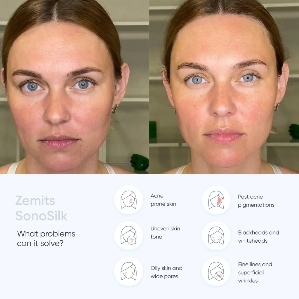 Zemits_SonoSilk2.jpg.webp